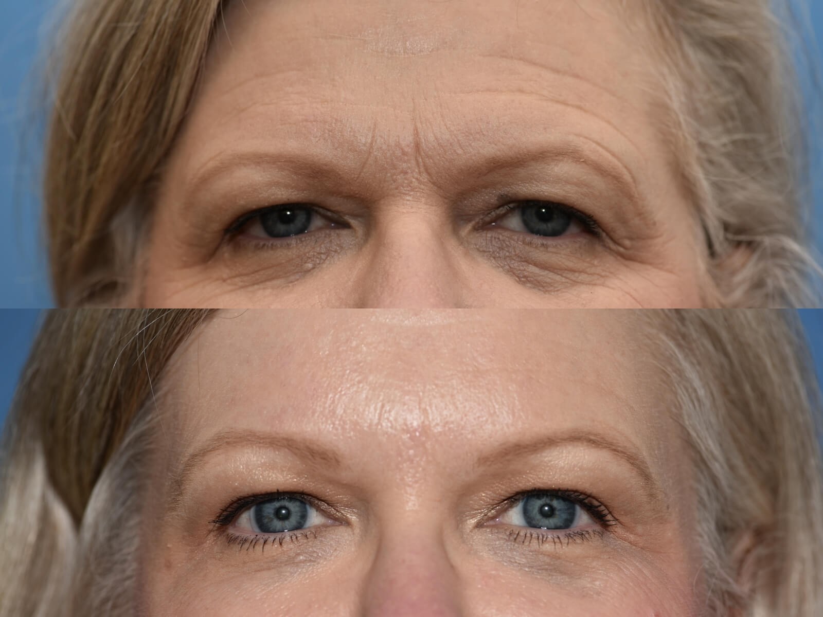 Fat transfer, Browlift Houston After