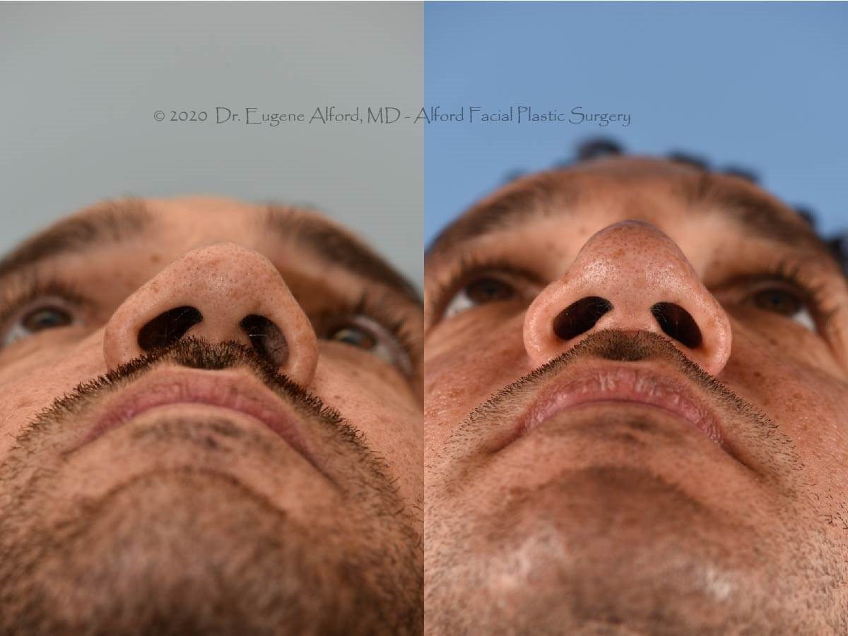 Functional Rhinoplasty Houston After