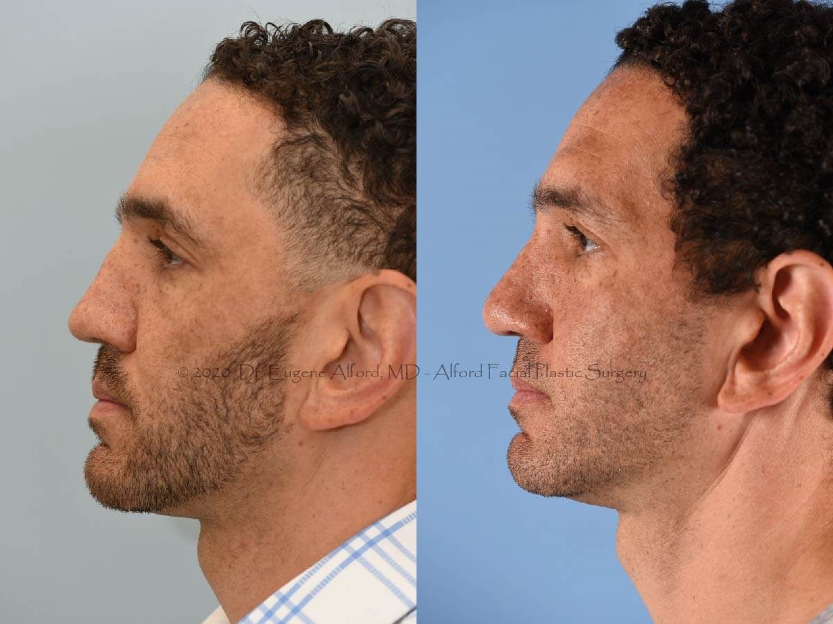 Corrected Deviated Septum Before
