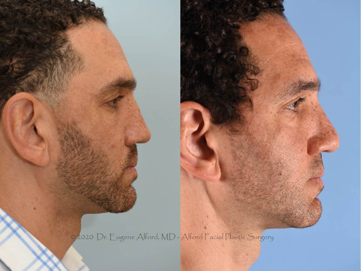 Corrected Deviated Septum After