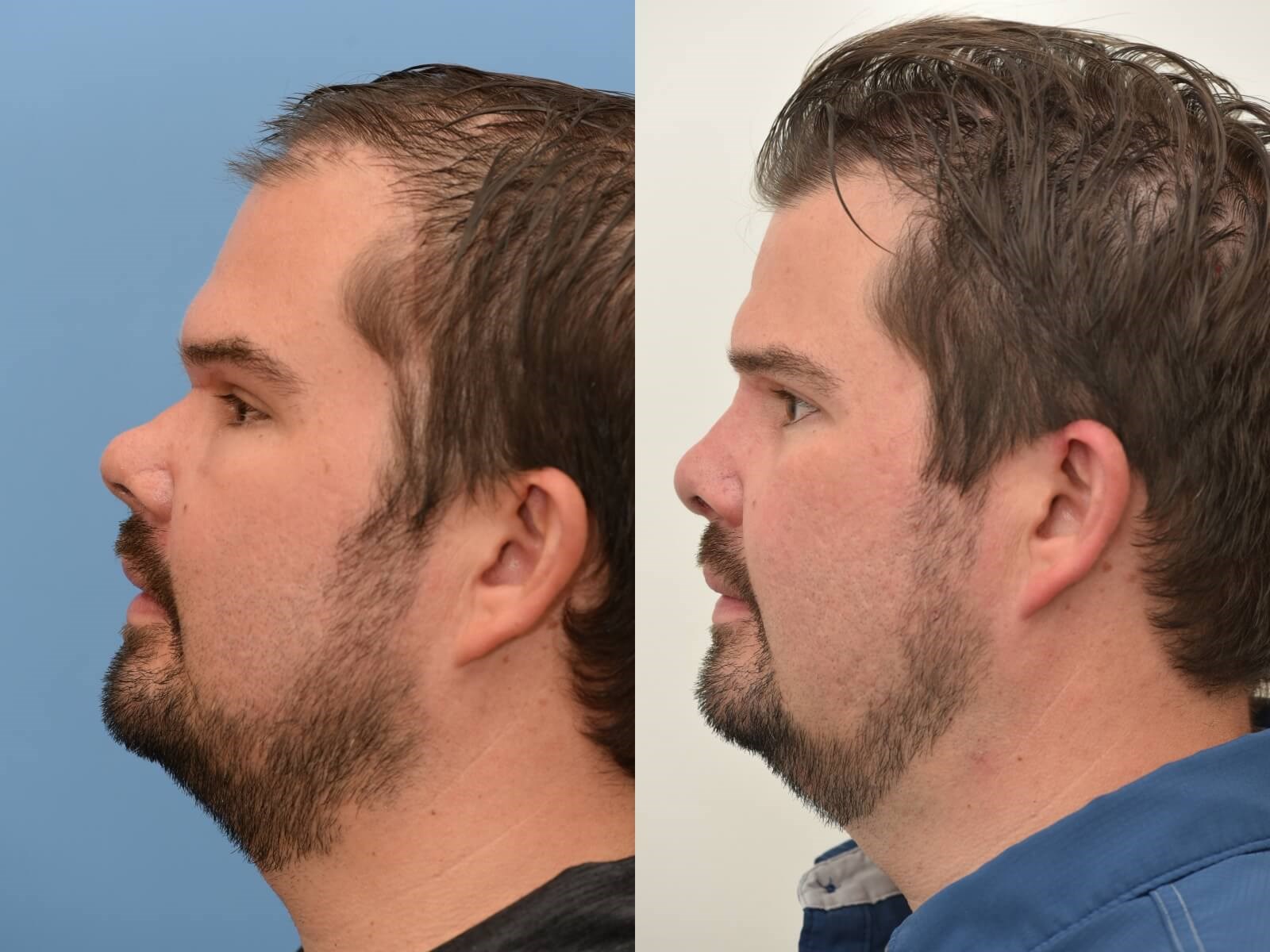 Sinus Surgery with Septoplasty Before
