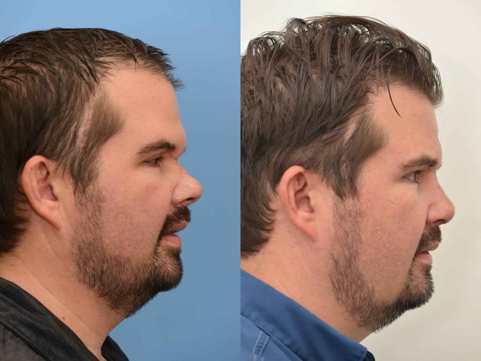 Sinus Surgery with Septoplasty After