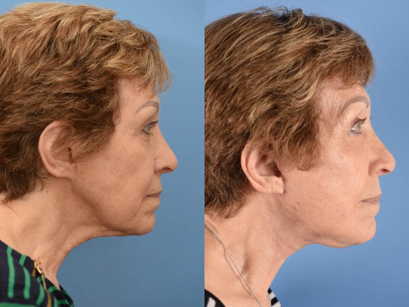 Facelift & Necklift Houston Before