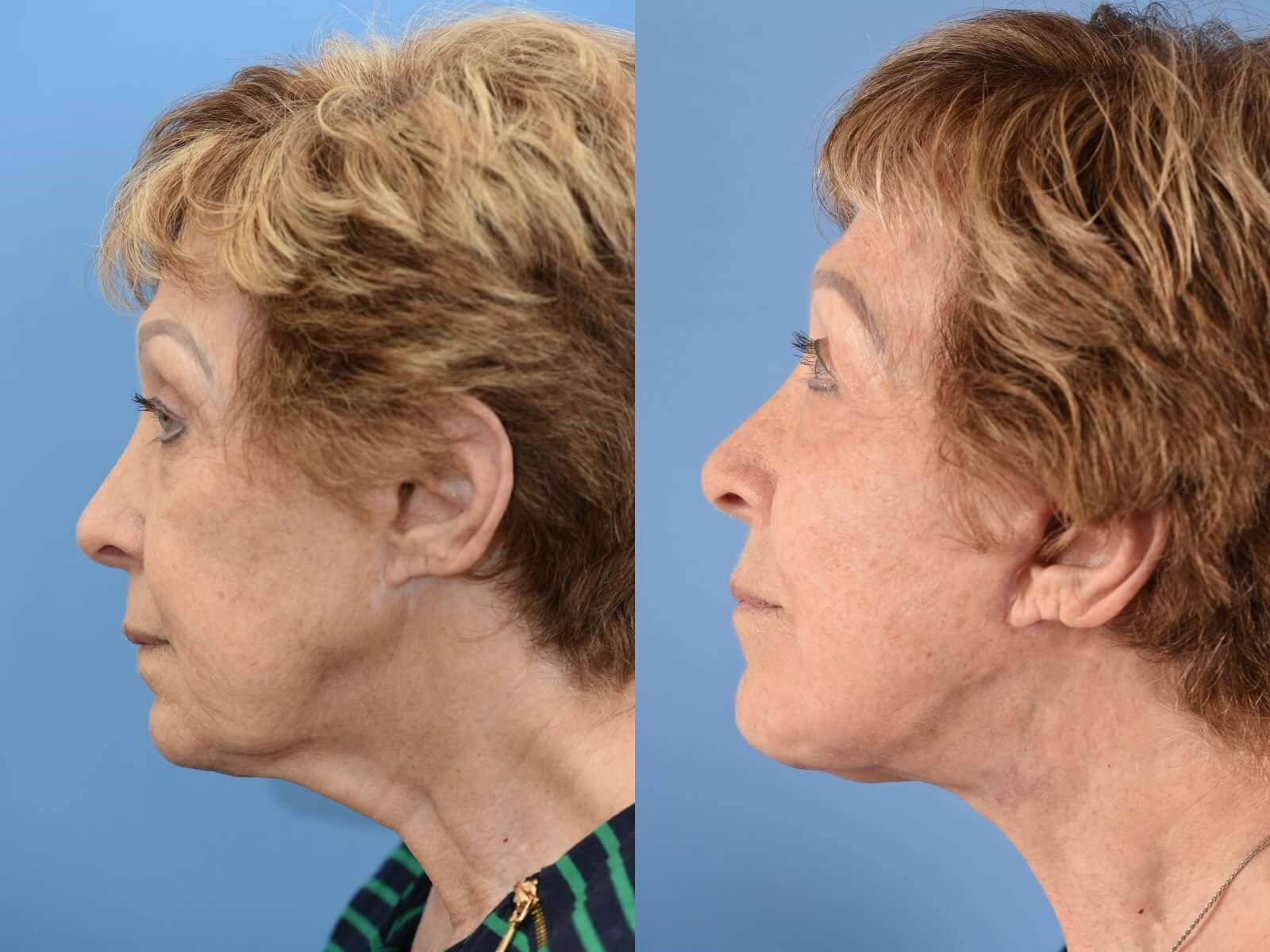 Facelift & Necklift Houston After