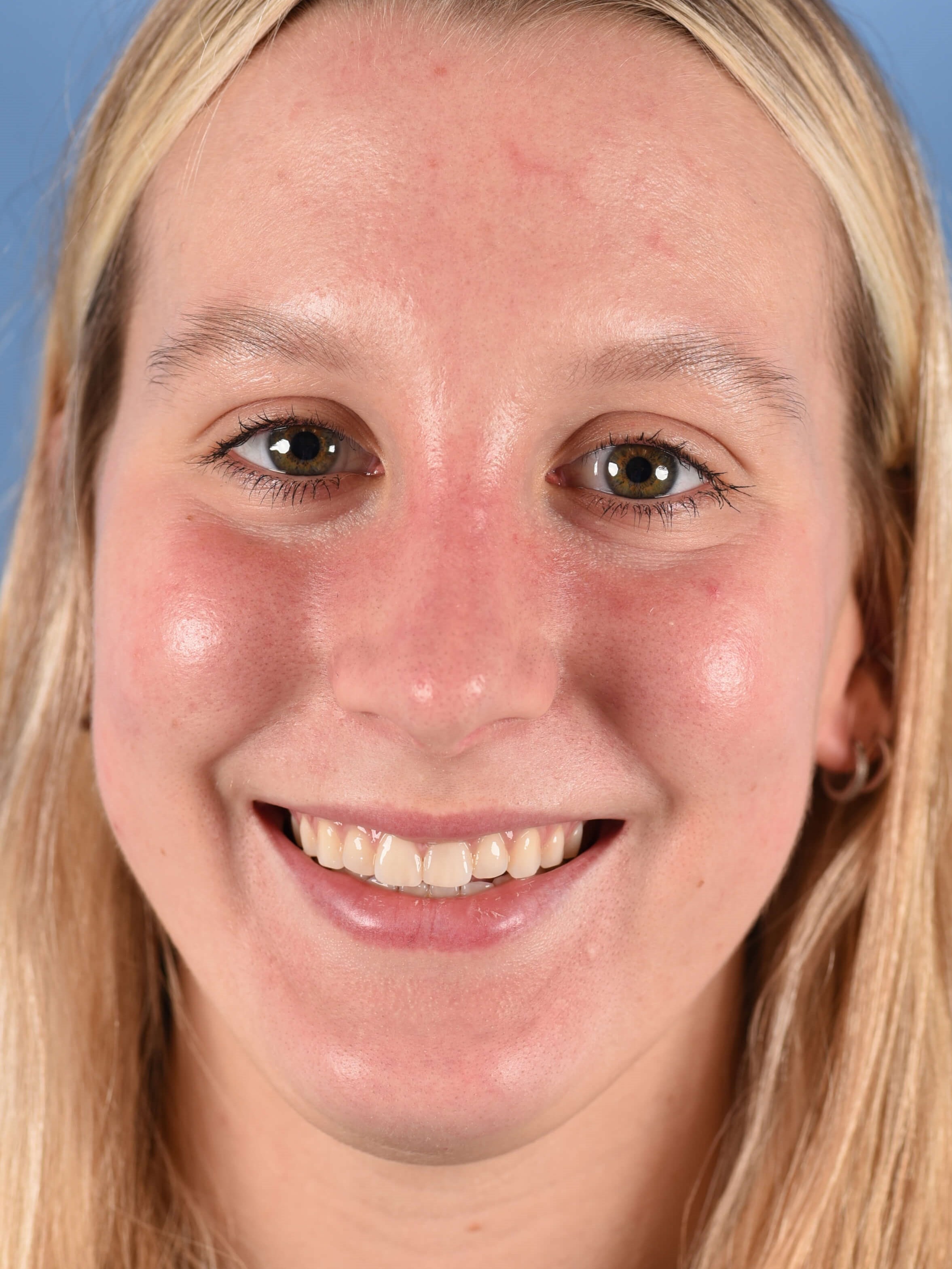 Revision Rhinoplasty Houston After