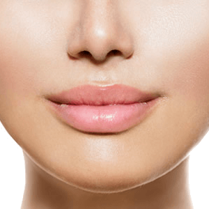 Lip Lift
